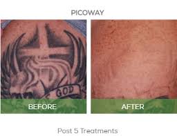 I'm hoping that reading this post will. Tattoo Removal Cade Clinique