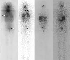 Learn about the signs and symptoms of thyroid cancer. Bone Metastases Of Differentiated Thyroid Cancer Impact Of Early 131i Based Detection On Outcome In Endocrine Related Cancer Volume 14 Issue 3 2007