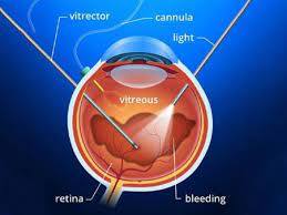 Check spelling or type a new query. Vitrectomy Surgery Risks And Postoperative Care Neoretina