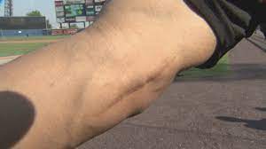 Frank jobe, the procedure that we now know as tommy john surgery has since become commonplace among big league players. Why Are So Many Pitchers Requiring Tommy John Surgery Youtube