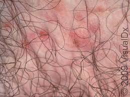 Image result for scabies on genitals