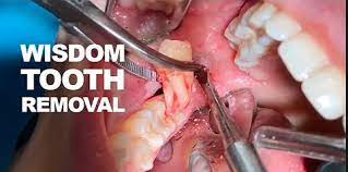 You want to limit the amount you irritate the sites that are healing, and avoid straining your jaw muscles by trying to eat food that is. Things To Avoid After Wisdom Teeth Extraction Super M Fitness