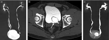 Image result for Helical CT Urogram