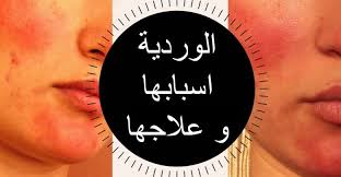 ما هو مرض الوردية وكيفية علاجه
