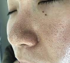 いちごのような毛穴汚れを解消する方法とは 毛穴 黒ずみ いちご鼻 毛穴 汚れ