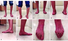 Image result for Genu Varum