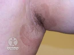 Image result for Erythrasma