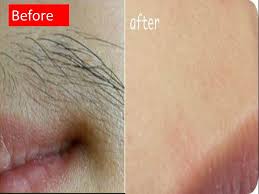 Chickpea flour, known as besan or gram flour, can be used to make an excellent face pack for exfoliating your skin and removing dead skin cells.furthermore, chickpea flour is effective in lightening the skin color and getting rid of facial hair. How To Get Rid Of Facial Hair Naturally Permanently At Home Remove Facial Hair Naturally At Home Youtube