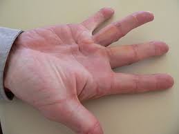 Pin On Dupuytren S Contracture