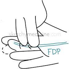 The fds to the middle finger is tested by holding the other 3 fingers in full extension, thereby immobilizing the profundis fdp (shown in black), and asking the patient to bend the finger. note that the fdp flexes the dip specifically, but will also flex the pip indirectly as well. Hand Exam Motor 2 13 Flexor Digitorum Profundus Fdp Sketchy Medicine
