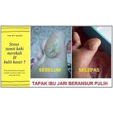 Cium tangan mereka cium kaki mereka bersujudlah,bersujudlah. Krim Tummit Untuk Tapak Kaki Merekah Pecah Shopee Malaysia