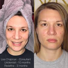 Acne-safe products and bi-weekly treatments for clear skin