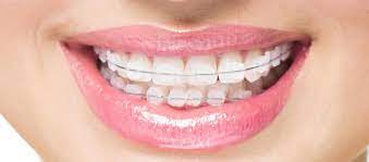 Headgear is to be worn daily for the number of hours specified by your dentist. Craft Your Smile Straighten Teeth Without Braces Pediatric Dentist In Nacogdoches Tx