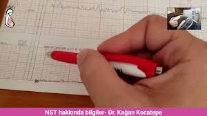Bu test genellikle hamileliğin 32. Nst Nonstres Test Nasil Okunur Ve Yorumlanir