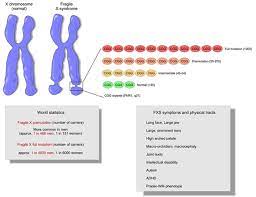 What Is Fragile X Syndrome