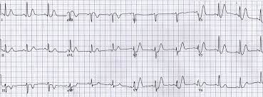 Right ventricular hypertrophy (mitral stenosis) old posterior mi. De Winter T Wave Litfl Ecg Library Diagnosis