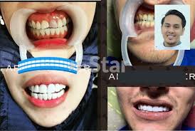 Nikmati juga pengalaman menyenangkan & lebih hemat. Gelinya Mulut Bau Busuk Tak Boleh Tutup Risiko Pakai Veneer Palsu Doktor Kata Jangan Terjebak Harga Promosi Viral Mstar