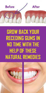 Natural Ways To Reverse Receding Gums Without Surgery Receding Gums Reverse Receding Gums Teeth Health
