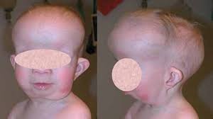 Silver-Russell syndrome: MedlinePlus Genetics