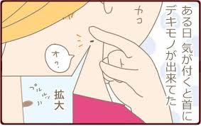 前回までは足裏のイボ 一話目 全4話です について描きましたが 実は首にもイボができて自分で取ったので その経緯を今回は描かせて頂こうと思います 1 首イボを糸で取る 首にできる小さなイボ 気になりますよね 根元が細い小さなものはハサミで切っても良いそう