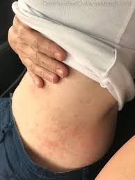 This one was due to an iv, but. Drugs And Donuts One Hundred Dollars A Month