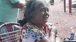 Pregnant' pensioner, 81, dies a day after surgery to remove ultra-rare  'stone baby' foetus she had been carrying inside her for 50 years in Brazil 