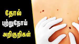 The strongest risk factor for developing skin cancer is ultraviolet (uv) ray exposure, typically from the sun. Skin Cancer Symptoms Skin Care Tips In Tamil Tamil Health Beauty Tips Youtube