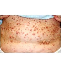 Neurofibromatosis, also known as nf, is a genetic disorder that affects 1 in every 3,000 people. Neurofibromatosis Von Recklinghausen Disease Central Neurofibromatosis Schwannomatosis Neurilemmomatosis Dermatology Advisor