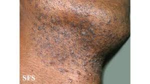 Image result for skin rash similar to scabies