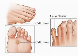 Por qué salen las durezas y los callos? - Clínica Lafuente Arcos