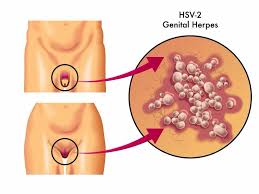 In rare cases, as when someone's immune system is severely compromised, this virus can cause infection of the brain (encephalitis), requiring intravenous therapy. Genital Herpes Symptoms