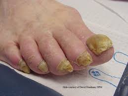 Effective Treatment For Toenail Fungus In Indianapolis Indiana Podiatry Group