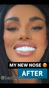 Soo pleased with the results!! 💁‍♀️🤩😊😃🥰💁‍♀️#katieprice #thisisme