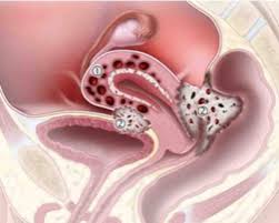 Diagnostics | Free Full-Text | Significance Of Pelvic Fluid Observed During  Ovarian Cancer Screening With Transvaginal Sonogram