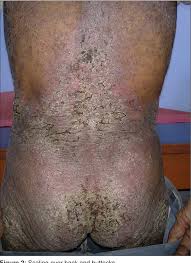 Image result for scabies norvegica
