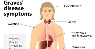 Graves' disease is the most common cause of hyperthyroidism, a disorder that causes the thyroid to produce too much thyroid hormone and can cause bulging eyes. Graves Disease Causes Symptoms Risk Factors Complications Diagnosis And Treatment
