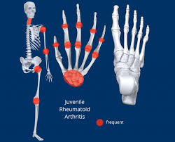 Image result for XRay Changes in Rheumatic Conditions