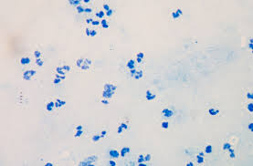 Remission means that the signs and symptoms of your cancer are reduced or gone, and the remission can be partial or complete. Measurable Residual Disease Is Prognostic Factor Before Transplantation In First And Second Remission Of Ph All Cancer Therapy Advisor