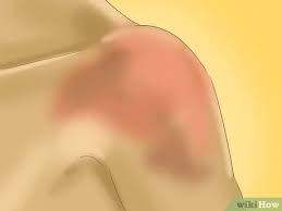 Bahu yang dapat bergerak dengan berbagai cara, akan mudah terluka. Cara Menyembuhkan Nyeri Bahu Untuk Atlet 10 Langkah