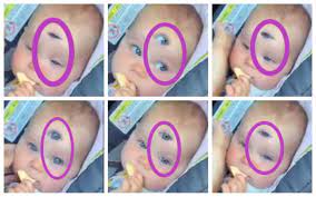 Fact Check Baby Born With 3 Eyes In Germany