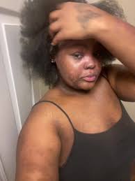 Early Stages of Plaque Psoriasis