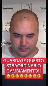 Trapianto di Capelli e Tricopigmentazione a Brindisi