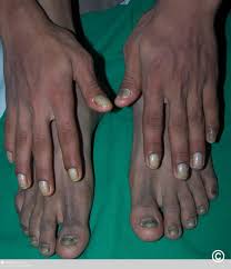 Image result for Yellow nail syndrome feet