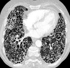 Nintedanib Slows Rate Of Fvc Decline In Fibrosing Interstitial Lung Diseases Pulmonology Advisor
