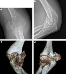Because it is the site of origin of the flexor/pronator mass and the elbow lateral collateral ligaments, avulsion fractures are particularly. Articular Fractures Of The Distal Humerus Sciencedirect