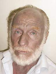 Argyria Permanent Skin Discoloration Following Protracted Colloid Silver Ingestion Bmj Case Reports