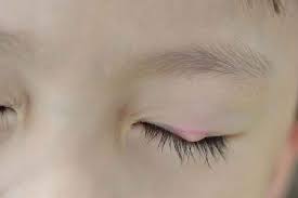 Tak bisa di pungkiri bahwa setiap orang baik disadari maupun tidak disadari pernah mengalami apa yang. Tips Sederhana Menyembuhkan Benjolan Di Kelopak Mata Alodokter