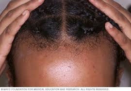 Bald spots and hair loss (alopecia) may not be related to the headaches but could be present at the same time. Hair Loss Symptoms And Causes Mayo Clinic
