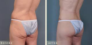 What is breast ptosis or breast sagging? Brazilian Butt Lift Before And After Colorado Plastic Surgery