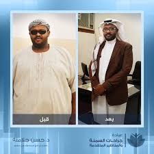 Before And After Weight Loss صور قبل و بعد عملية التكميم عيادات جراحة السمنة والمناظير المتقدمة